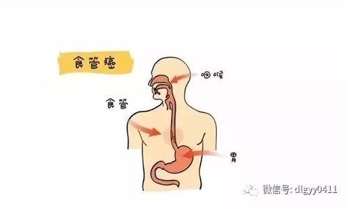 北京中日友好医院中西医肿瘤内科程志强博士,回答中医能否治疗食管癌的问题