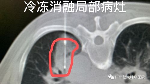 北京肿瘤医院选择广州复大肿瘤医院 微创治疗 肺癌