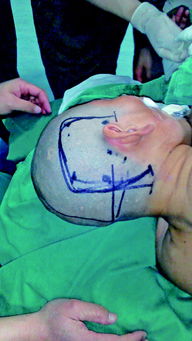 妙手施仁术，医学创奇迹——北京治疗性病新突破