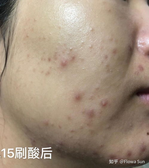 痤疮与糠秕孢子菌毛囊炎的治疗过程及注意事项