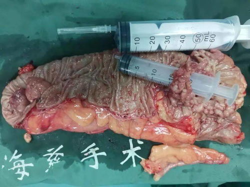 海慈医疗集团肛肠科成功救治结肠癌患者，专业诊疗显成效
